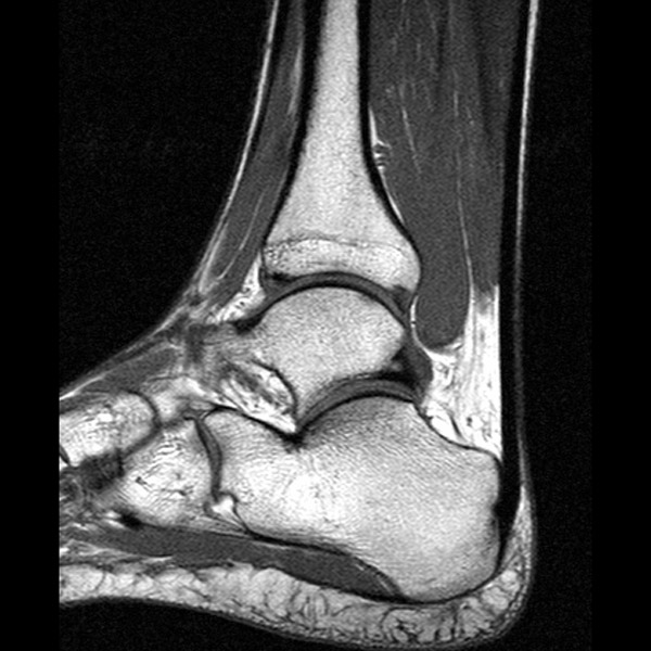 Magnetna rezonanca skocnog zgloba i stopala
