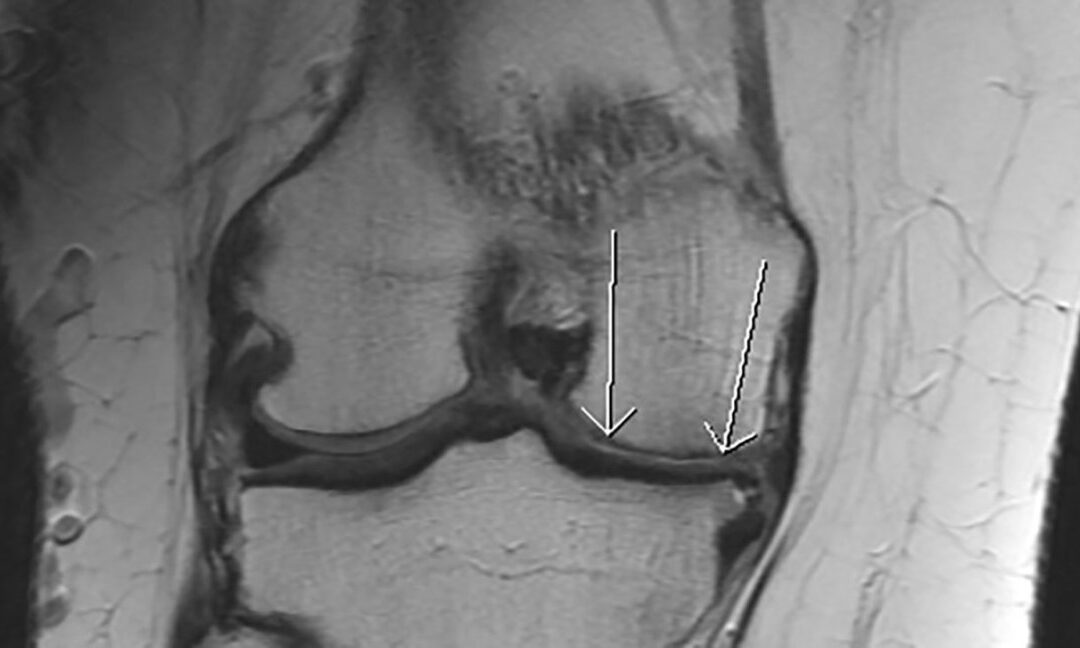 Magnetna rezonanca perifernih zglobova kod reumatskih oboljenja