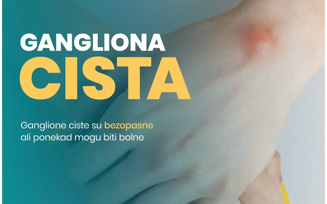 Gangliona Cista