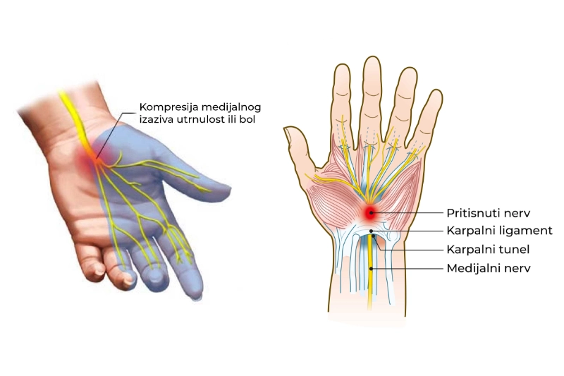 sindrom-karpalnog-tunela-artromedic-nis-1 Sindrom karpalnog tunela - Artromedic Niš